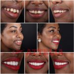 Smile Makeover in Turkey, Hollywood Smile Design | New Teeth Turkey ...