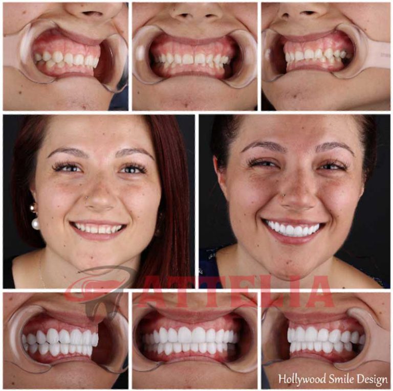 Smile Makeover In Turkey, Hollywood Smile Design | New Teeth Turkey ...