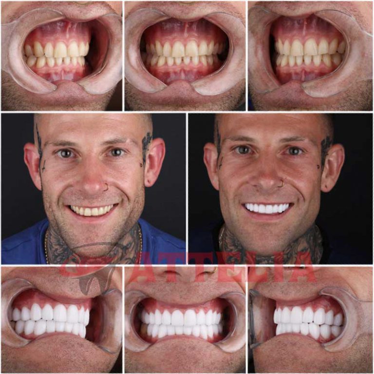 Smile Makeover In Turkey Hollywood Smile Design New Teeth Turkey